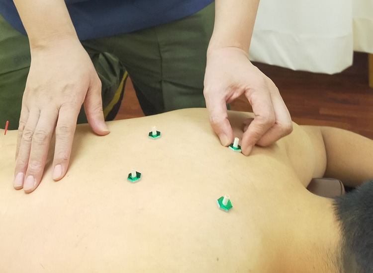 灸治療